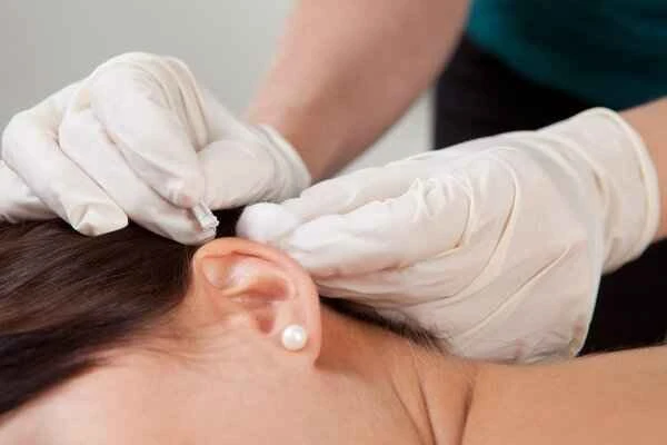 How to cover up keloid scars from ear piercings
