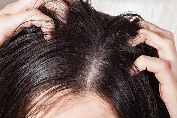 How to reduce dandruff in winter