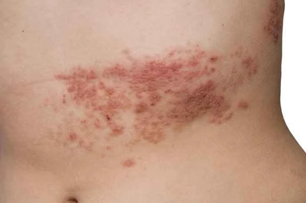 Symptoms of reverse psoriasis