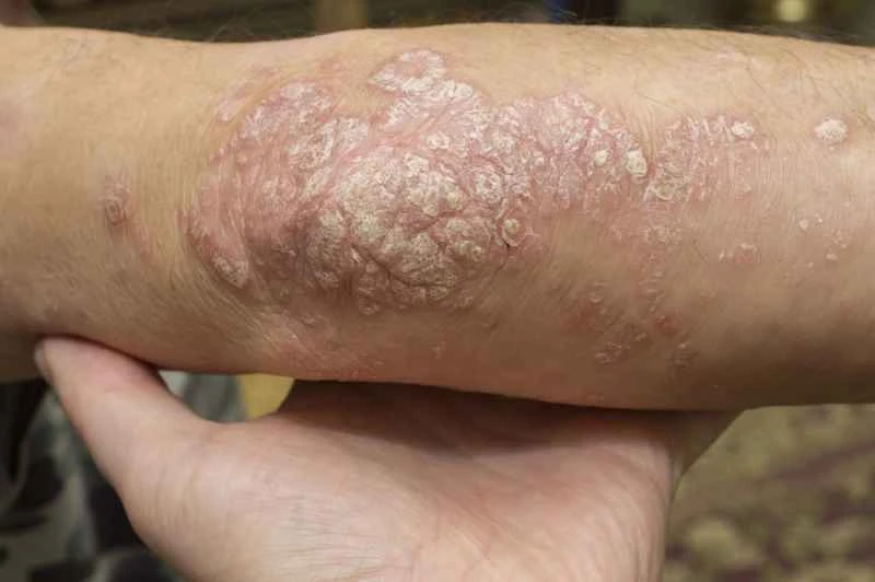 What diseases can dry eczema cause?