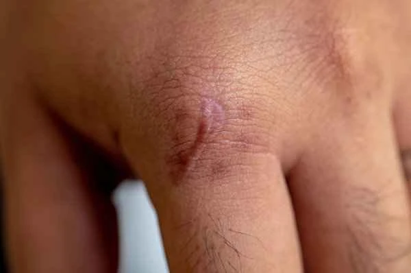 How to remove silicone gel membrane scars?