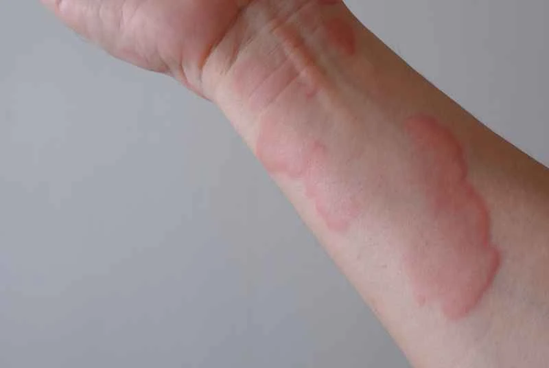 What medicine can help hives heal faster?