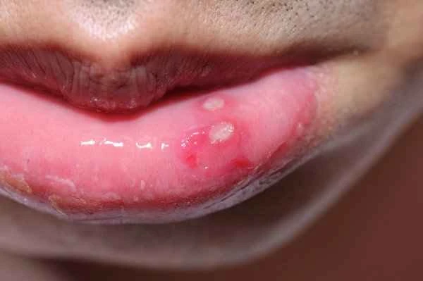 Is peeling skin on the lips a symptom of cheilitis?
