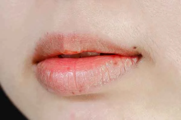 What causes lips to constantly peel and crack?