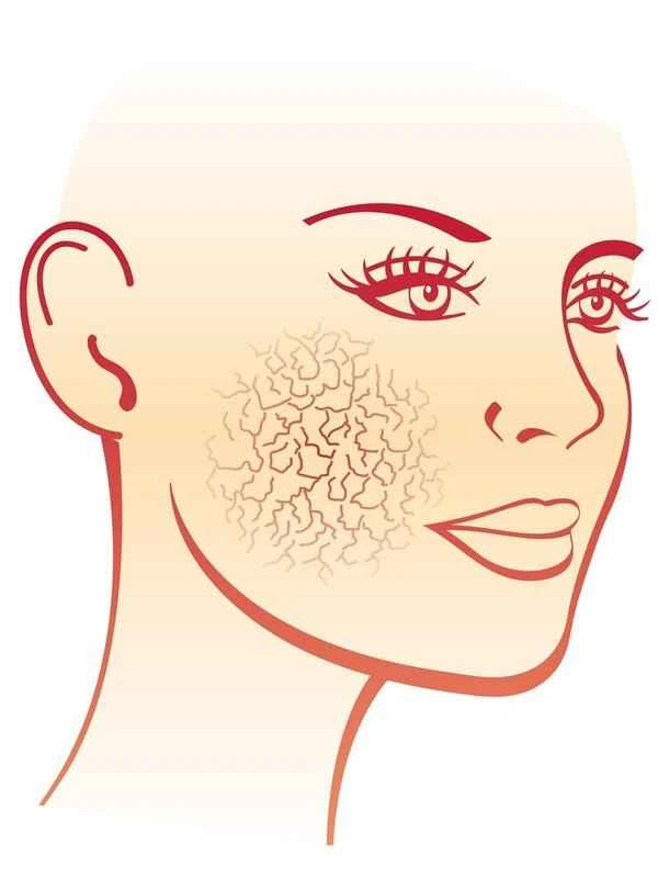 Dry, flaky skin on face and nose