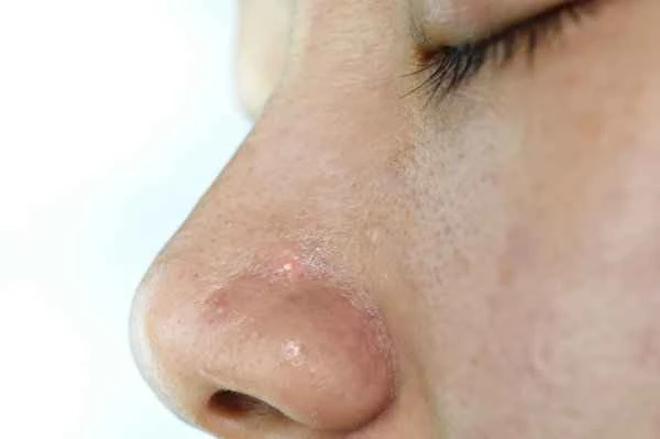 How do pimples form scars?