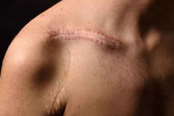 How long does it take for hypertrophic scars to soften?