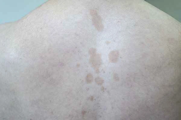 What causes small, grainy bumps on the sides of the nose?