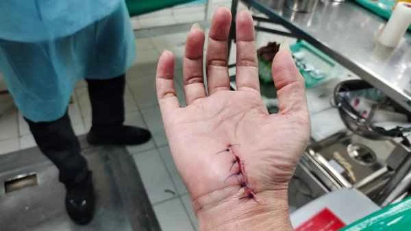 Can vitiligo patients undergo skin grafting?