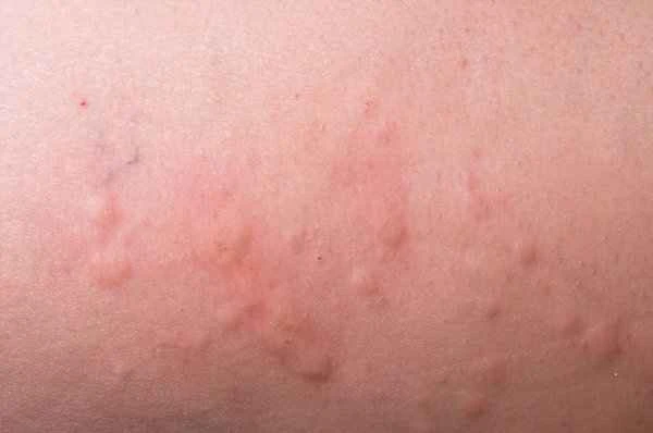 Where can I get treatment for chronic urticaria?