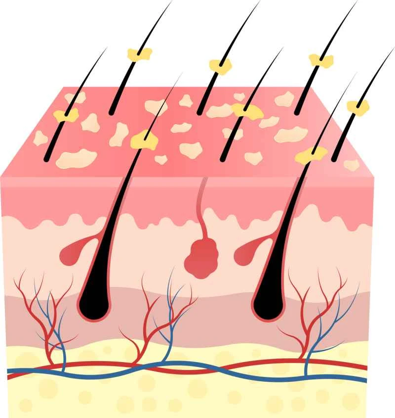Can scalp psoriasis spread to the rest of the body?