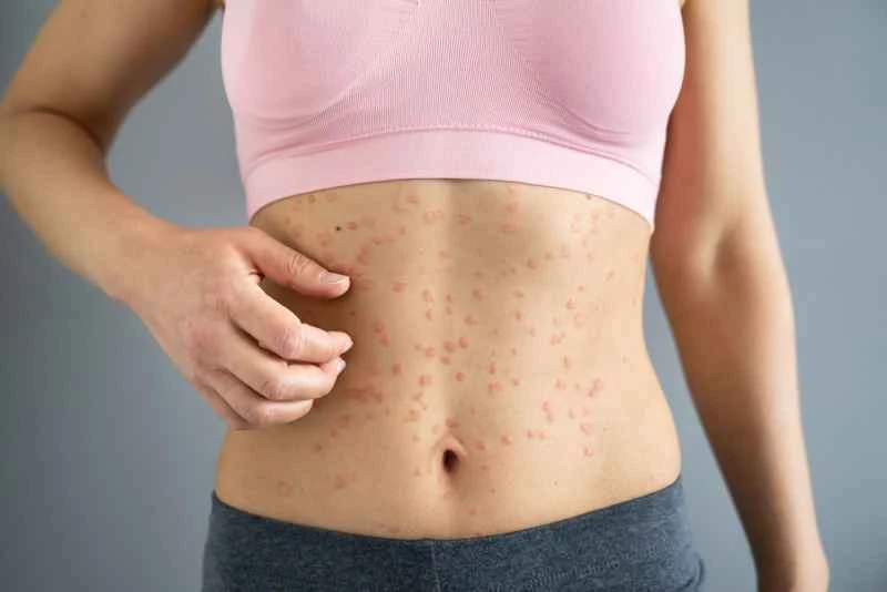 Is psoriasis contagious?