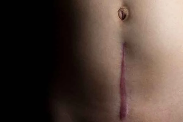 How long is the recovery period for minimally invasive scar surgery?