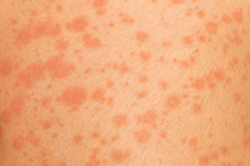 What causes urticaria?