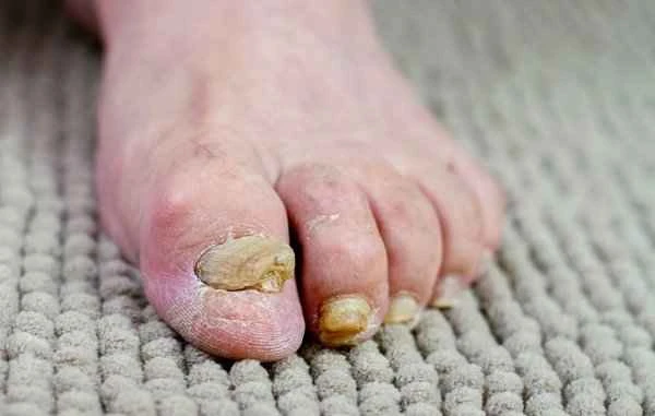 How to treat fungal infections on the soles of the feet