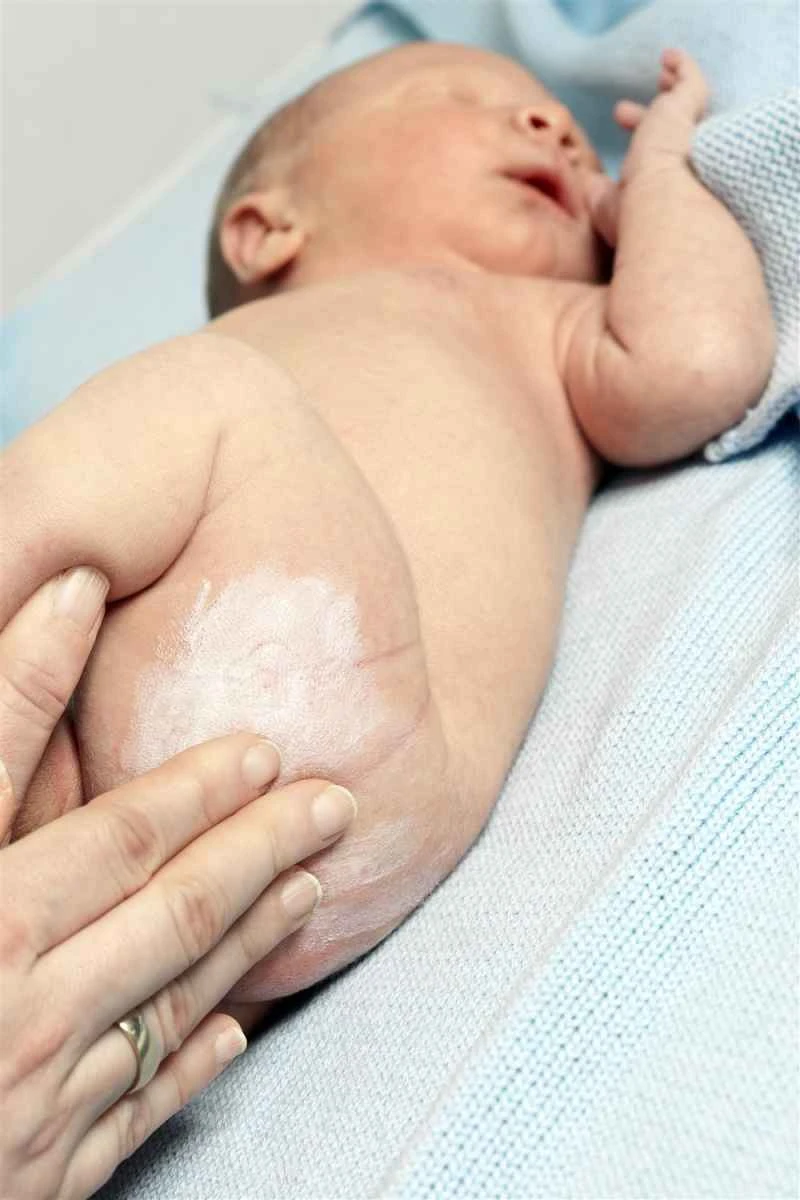 What is the best way to treat recurring baby eczema?