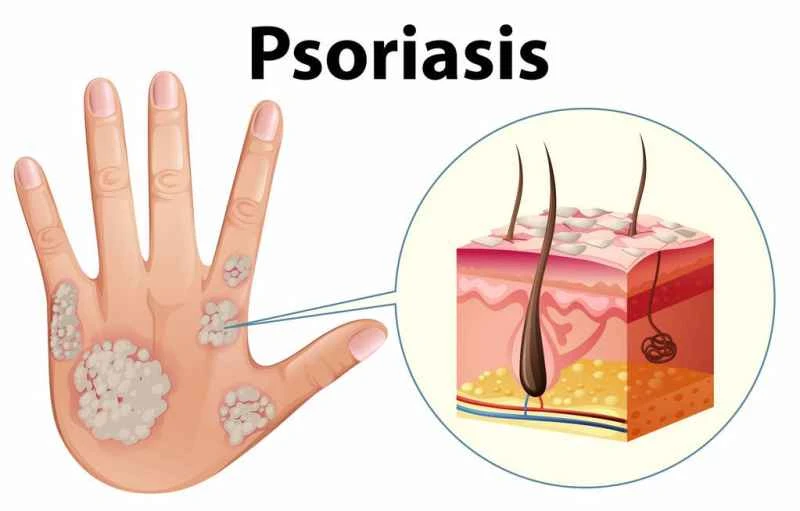What causes psoriasis?