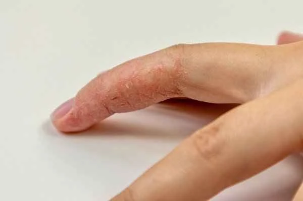 How to completely cure chronic eczema on the fingers