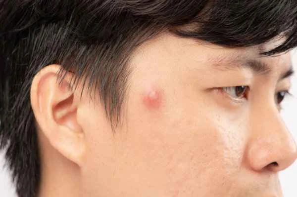 The difference between boils and tumors