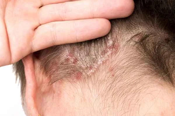 What medications are used for scrotal eczema and tinea?
