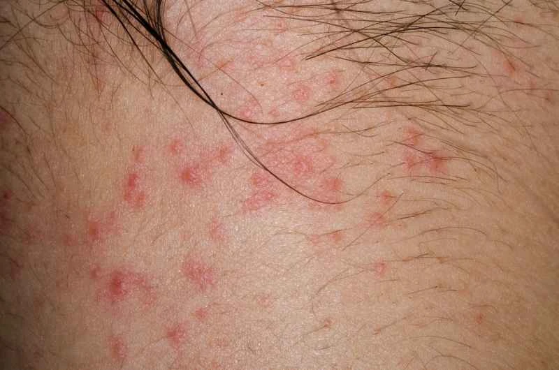 Can dermatitis eczema be cured completely?