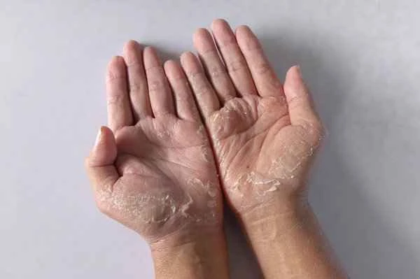 What causes cracked, itchy, and white skin on the hands?