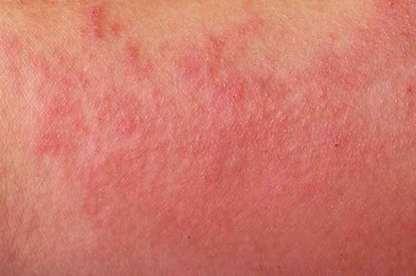 Difference between shingles and eczema