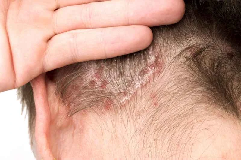 What causes psoriasis and how is it treated?