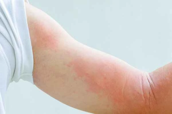How to treat eczematous urticaria?