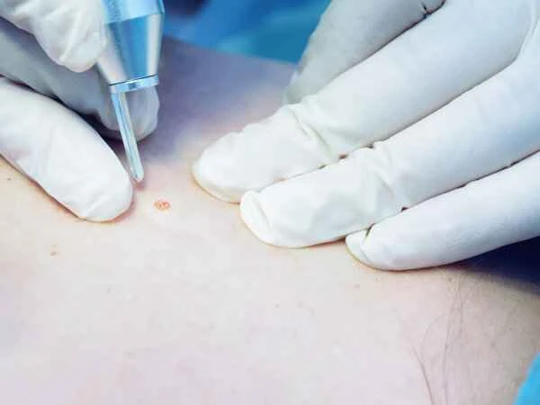 How to remove red scars on the face