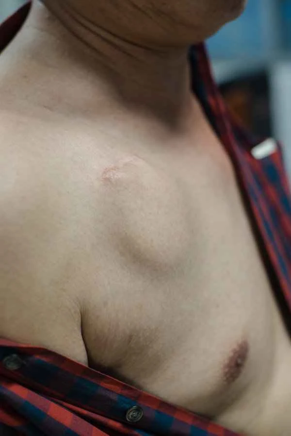 How to determine keloid scarring constitution