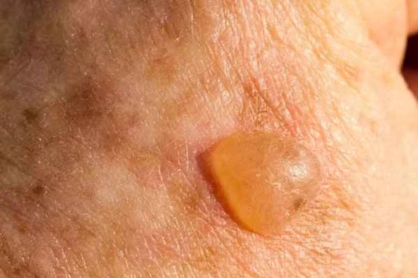 What causes scars to turn into blisters?