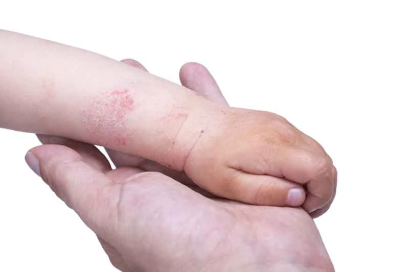 Can eczema on the body spread to the face?