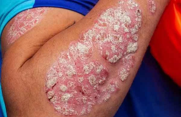 How to remove severe keloids