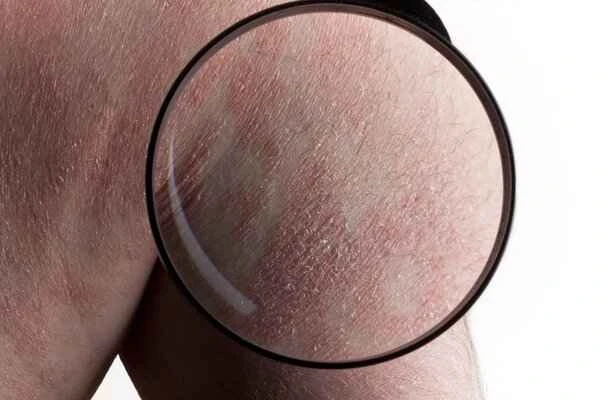 Symptoms of reverse psoriasis