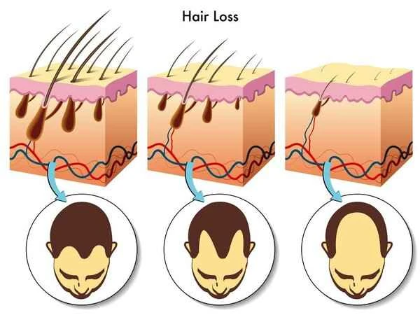 How to treat hair loss caused by clogged hair follicles?