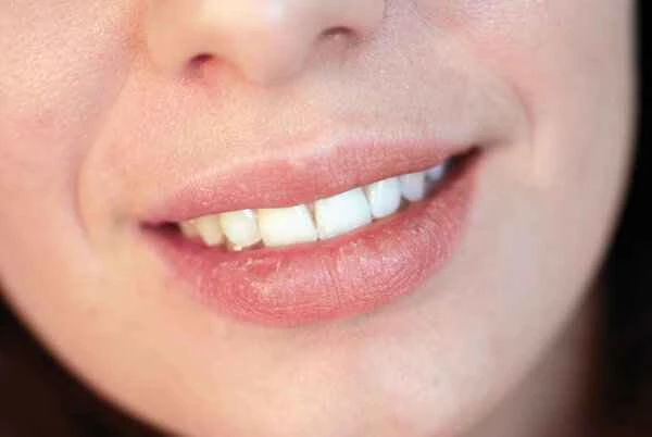 Is peeling skin on the lips a symptom of cheilitis?