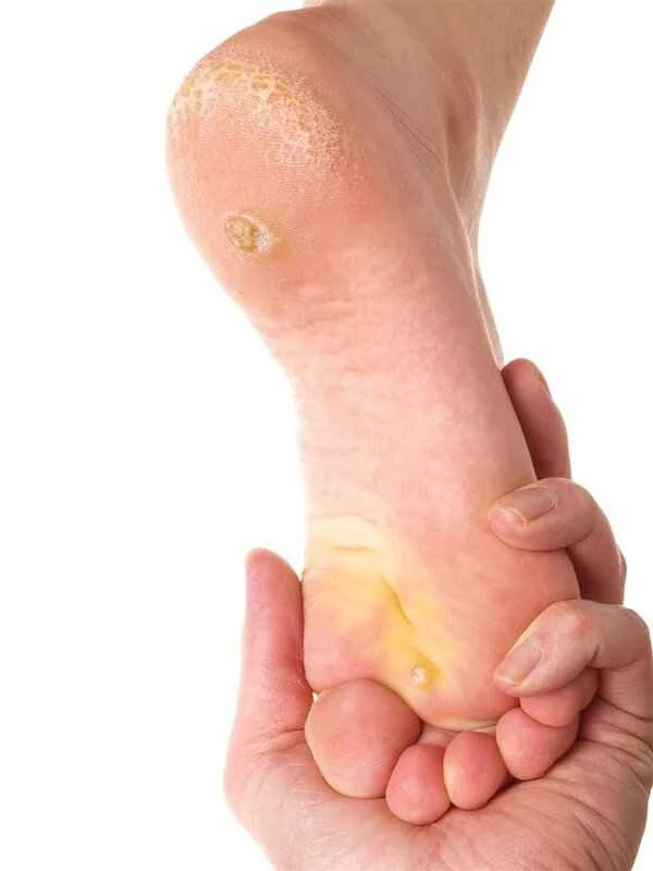 How to cure stubborn athlete's foot?