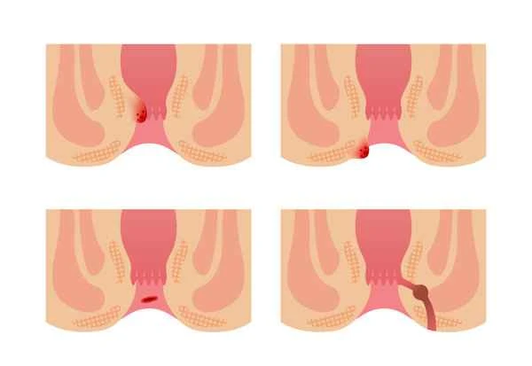 What causes a hard lump on the buttocks?