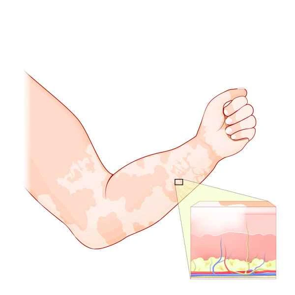 Will sweating cause vitiligo to recur?