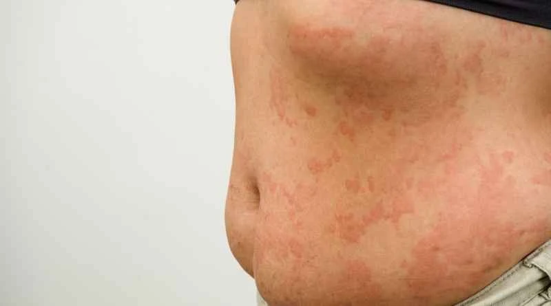 Is papular urticaria contagious in children?