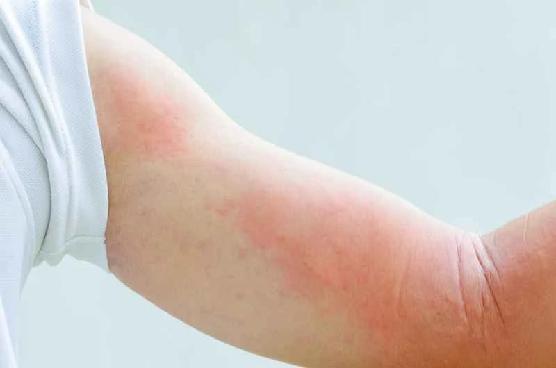 How long does it take for hives to heal during the infectious period?
