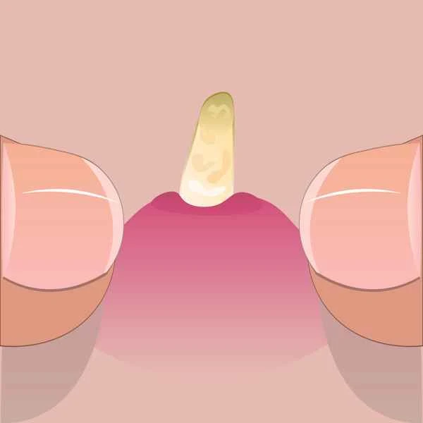 How long does it take for folliculitis and boils on the scrotum to heal?