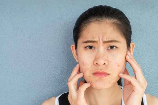 Can Botox injections remove acne?