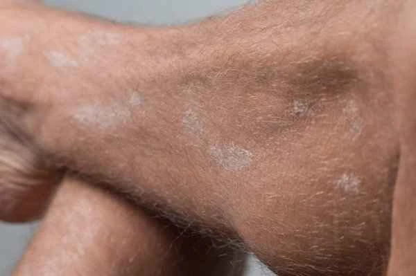 Can scrotal dampness cause tinea cruris?