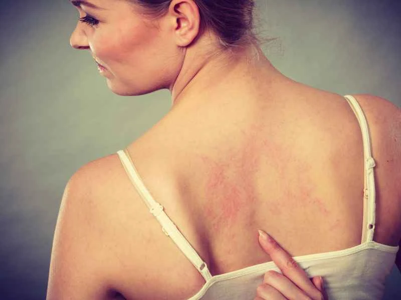 What medicine can cure urticaria?