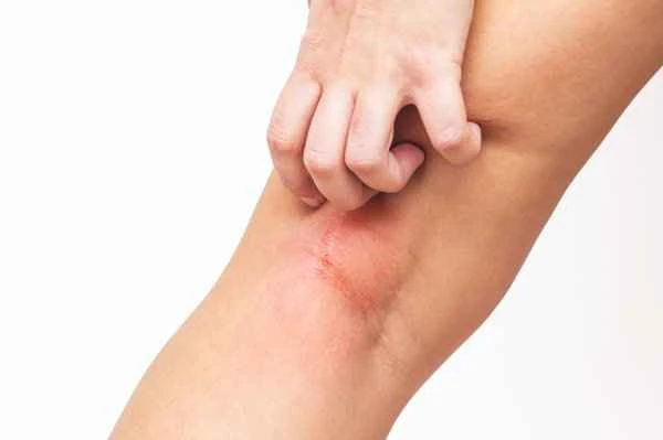 Itching persists for months after being bitten by an insect