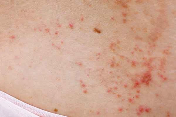 How to distinguish between urticaria and prickly heat