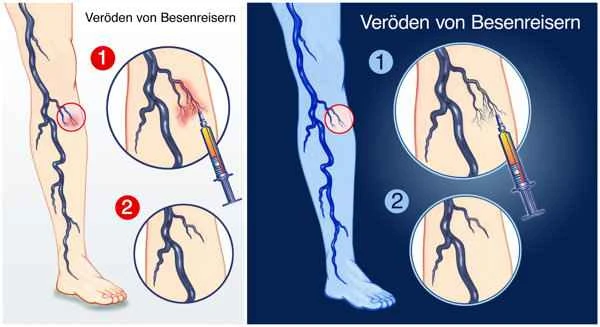 How to treat scar neovascularization effectively?