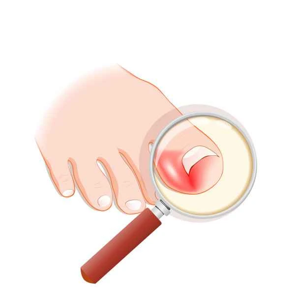 A hard lump, like a callus, has grown on my toe.